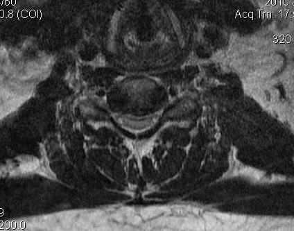 Cervical Myelopathy Compression Cord Ratio